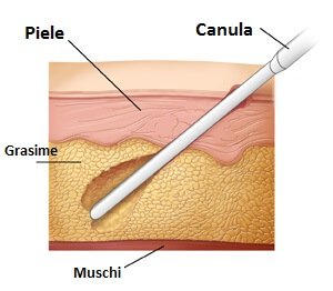 Liposucție femei - rezultat și proporție